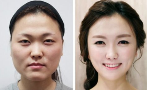Jaw reduction
